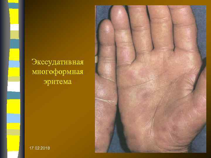 Экссудативная многоформная эритема 17. 02. 2018 