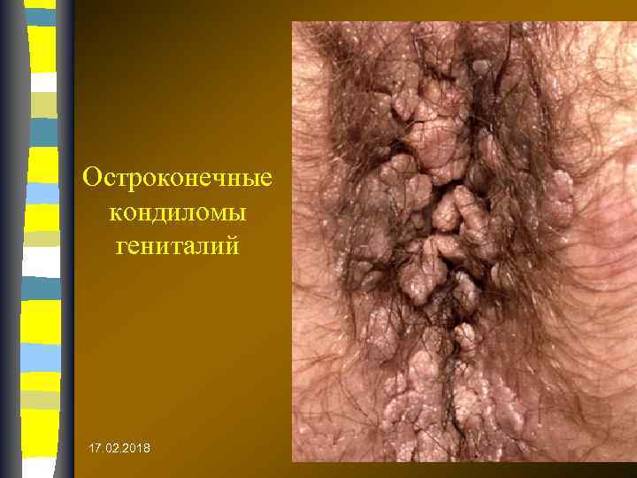 Остроконечные кондиломы гениталий 17. 02. 2018 