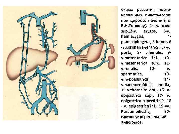 Схема развития портокавальных анастомозов при циррозе печени (по В. Н. Тонкову). 1 - v.