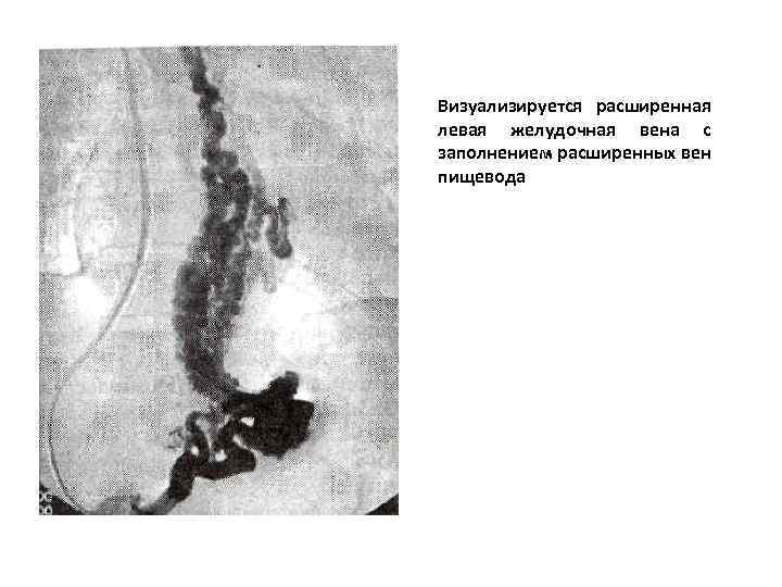 Визуализируется расширенная левая желудочная вена с заполнением расширенных вен пищевода 