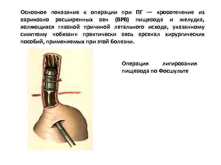 Основное показание к операции при ПГ — кровотечение из варикозно расширенных вен (ВРВ) пищевода