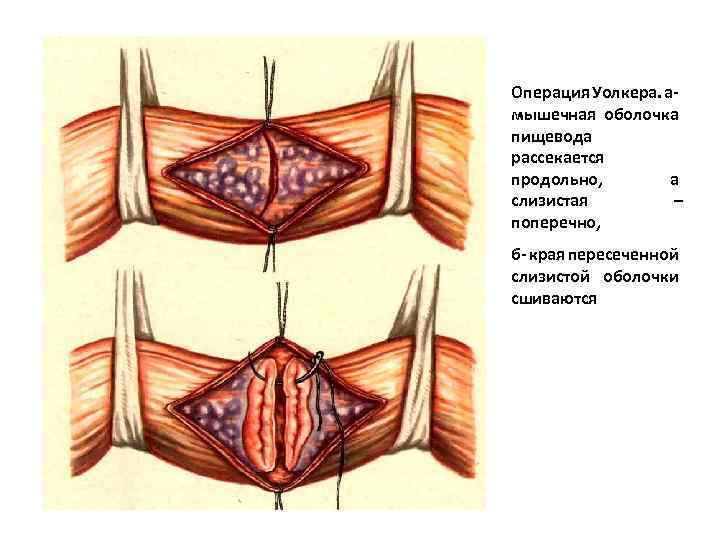 Операция Уолкера. а- мышечная оболочка пищевода рассекается продольно, а слизистая – поперечно, б- края