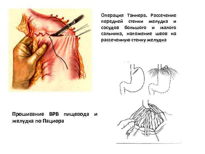Операция Таннера. Рассечение передней стенки желудка и сосудов большого и малого сальника, наложение швов