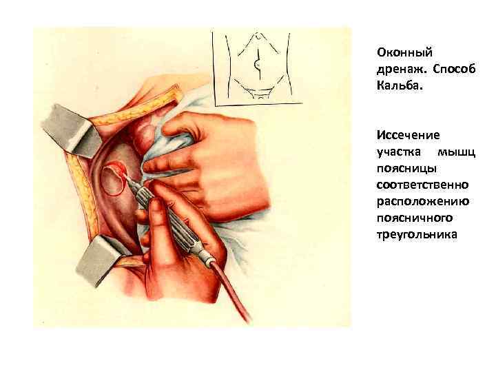 Оконный дренаж. Способ Кальба. Иссечение участка мышц поясницы соответственно расположению поясничного треугольника 