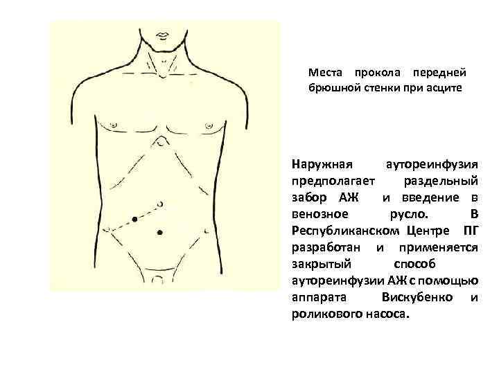 Места прокола передней брюшной стенки при асците Наружная аутореинфузия предполагает раздельный забор АЖ и