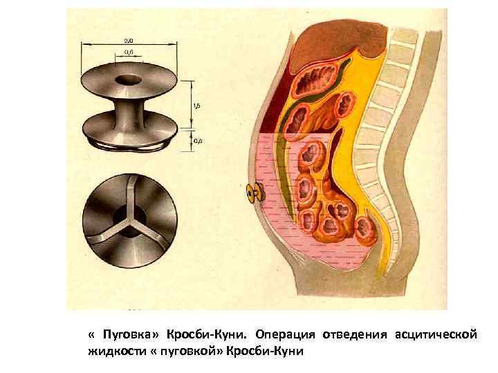  « Пуговка» Кросби-Куни. Операция отведения асцитической жидкости « пуговкой» Кросби-Куни 