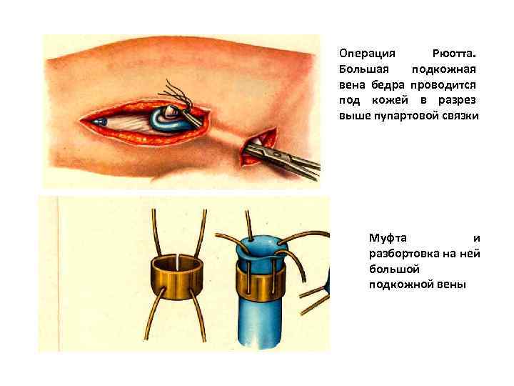 Операция Рюотта. Большая подкожная вена бедра проводится под кожей в разрез выше пупартовой связки