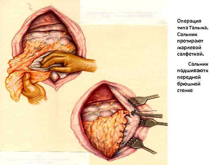 Операция типа Тальма. Сальник протирают марлевой салфеткой. Сальник подшивают к передней брюшной стенке 