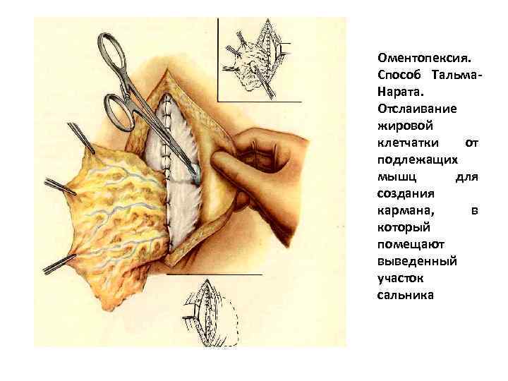 Оментопексия. Способ Тальма. Нарата. Отслаивание жировой клетчатки от подлежащих мышц для создания кармана, в