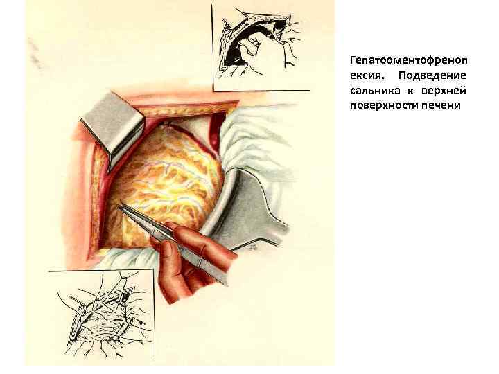 Гепатооментофреноп ексия. Подведение сальника к верхней поверхности печени 