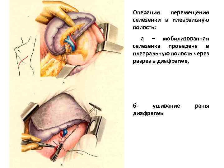 Операция перемещения селезенки в плевральную полость: а – мобилизованная селезенка проведена в плевральную полость