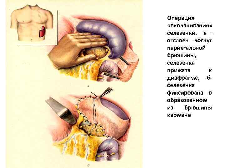 Операция «вколачивания» селезенки. а – отслоен лоскут париетальной брюшины, селезенка прижата к диафрагме, б-