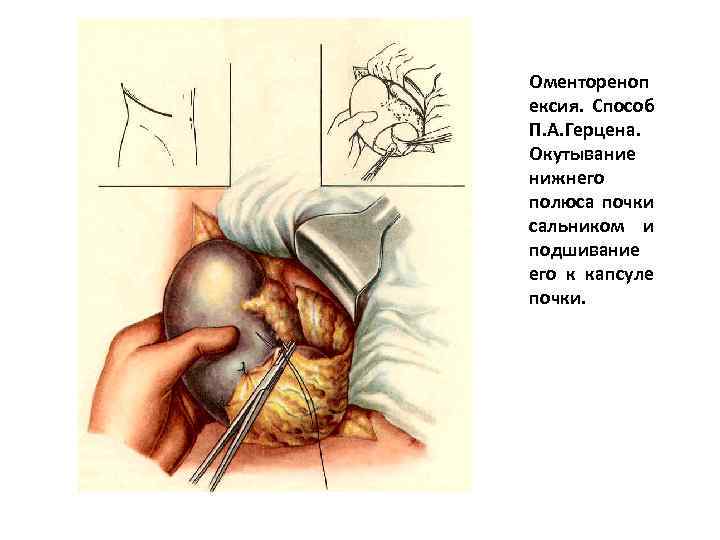 Оментореноп ексия. Способ П. А. Герцена. Окутывание нижнего полюса почки сальником и подшивание его