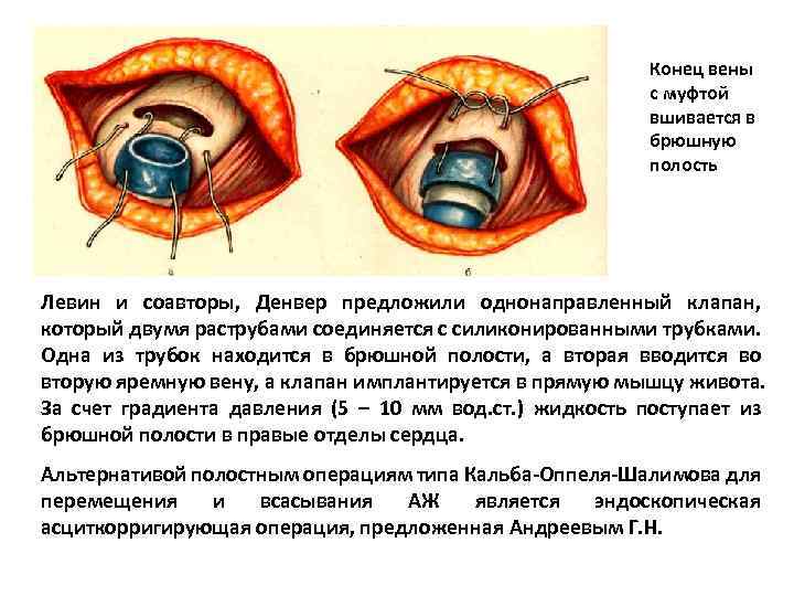 Конец вены с муфтой вшивается в брюшную полость Левин и соавторы, Денвер предложили однонаправленный