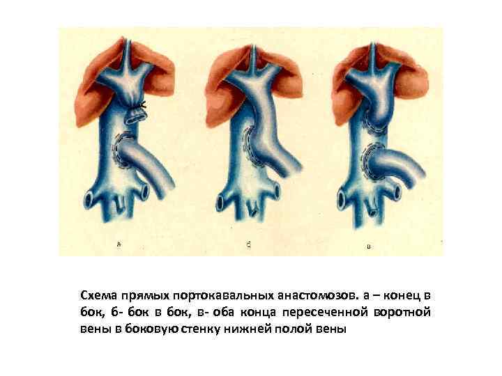 Схема прямых портокавальных анастомозов. а – конец в бок, б- бок в бок, в-