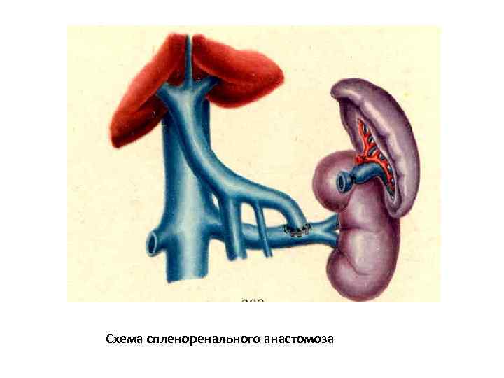 Схема спленоренального анастомоза 