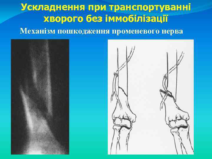 Ускладнення при транспортуванні хворого без іммобілізації Механізм пошкодження променевого нерва 