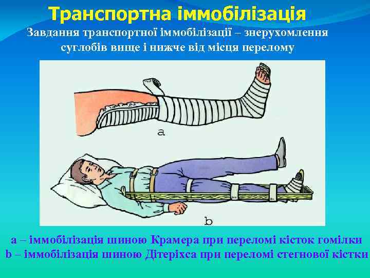 Транспортна іммобілізація Завдання транспортної іммобілізації – знерухомлення суглобів вище і нижче від місця перелому