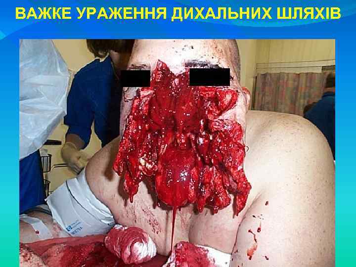 ВАЖКЕ УРАЖЕННЯ ДИХАЛЬНИХ ШЛЯХІВ 