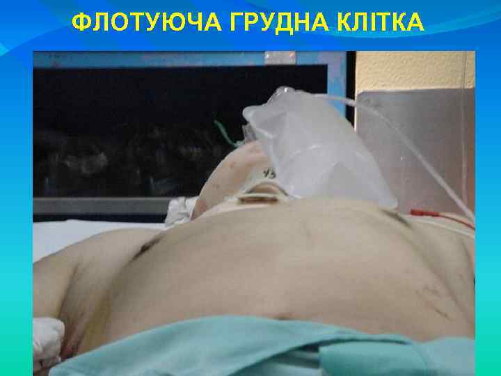 ФЛОТУЮЧА ГРУДНА КЛІТКА 