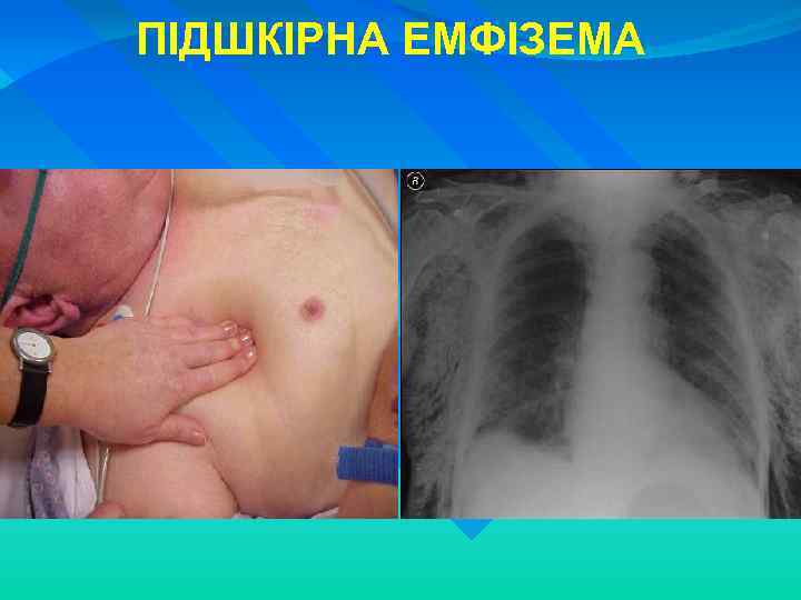 ПІДШКІРНА ЕМФІЗЕМА 