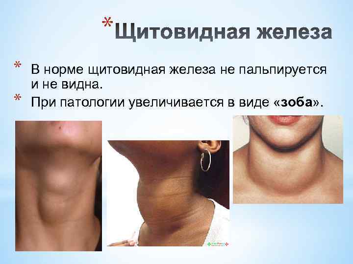 * * * В норме щитовидная железа не пальпируется и не видна. При патологии