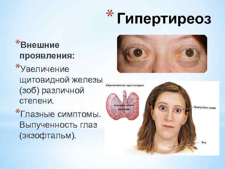 * Гипертиреоз *Внешние проявления: *Увеличение щитовидной железы (зоб) различной степени. *Глазные симптомы. Выпученность глаз