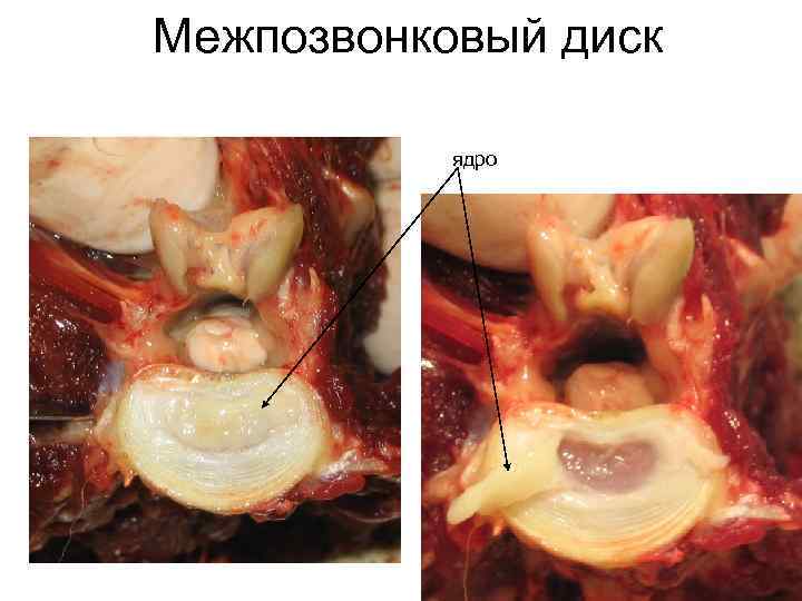 Межпозвонковый диск ядро 