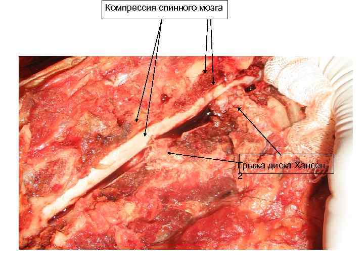 Компрессия спинного мозга Грыжа диска Хансен 2 