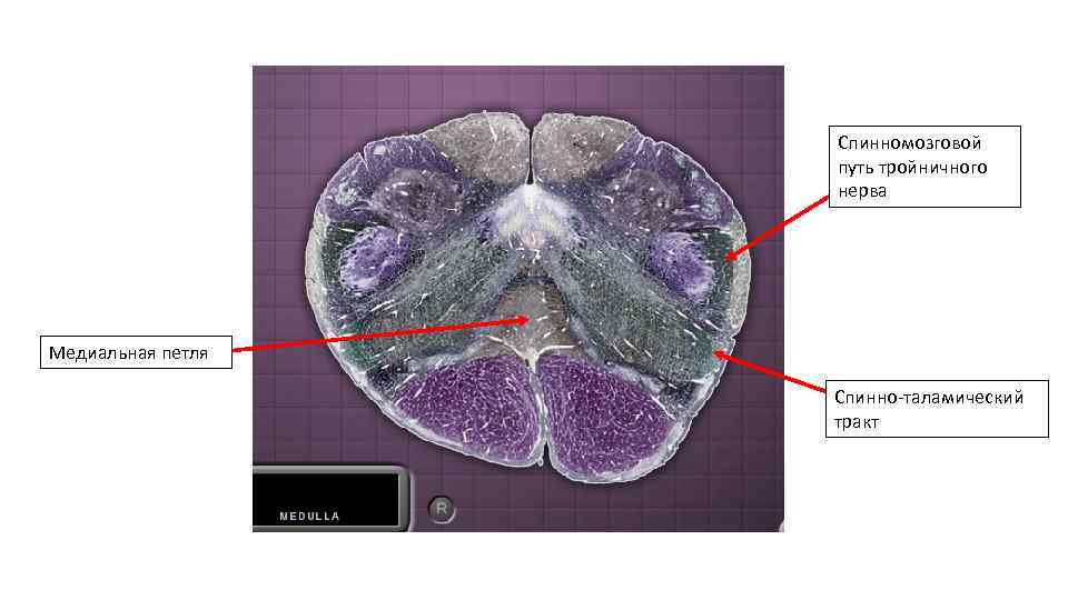 Спинномозговой путь тройничного нерва Медиальная петля Спинно-таламический тракт 