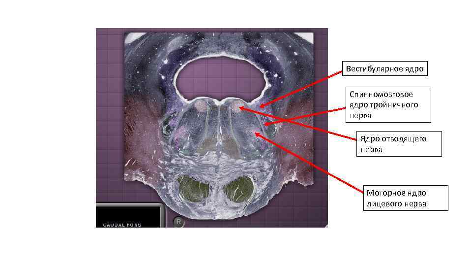 Вестибулярное ядро Спинномозговое ядро тройничного нерва Ядро отводящего нерва Моторное ядро лицевого нерва 