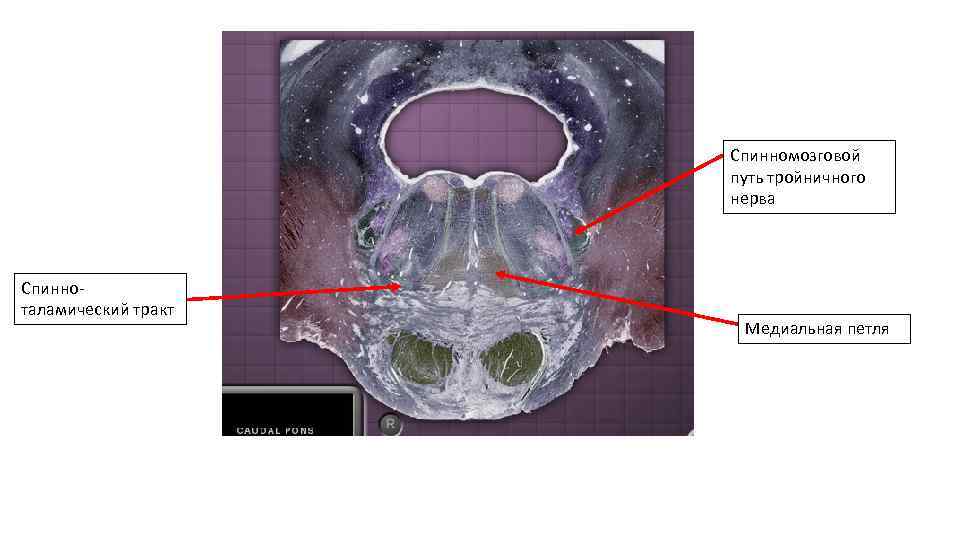 Спинномозговой путь тройничного нерва Спинноталамический тракт Медиальная петля 