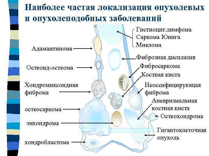 Рентгенологическая картина гигантоклеточной опухоли характеризуется разновидностями