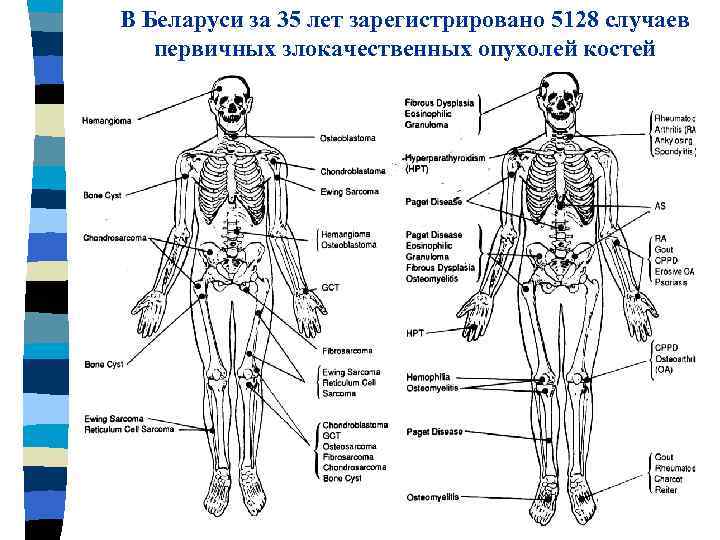 В Беларуси за 35 лет зарегистрировано 5128 случаев первичных злокачественных опухолей костей 