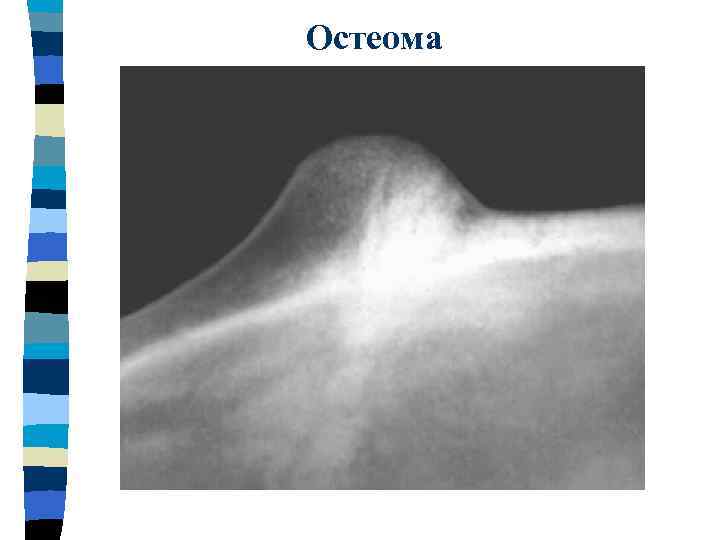 Остеома 