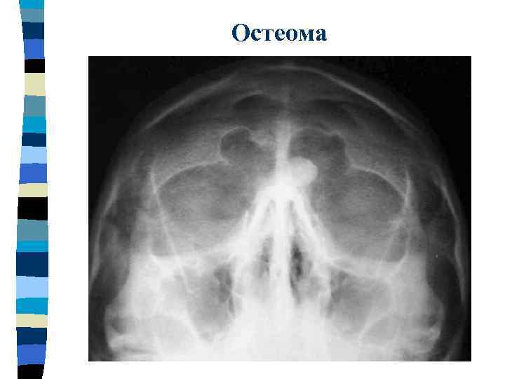 Остеома 