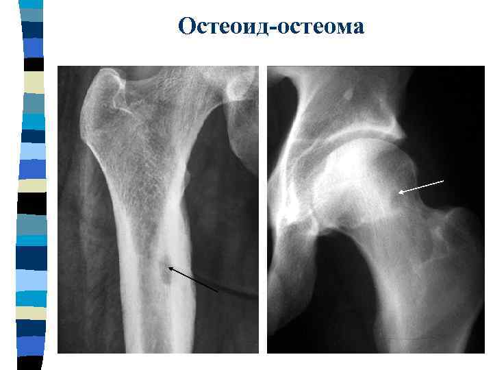 Остеоид остеома бедренной кости