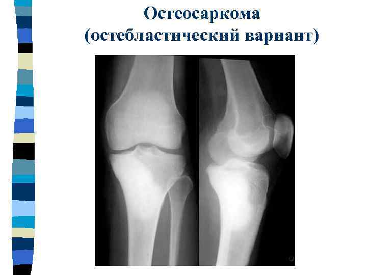 Рентгенологическая картина гигантоклеточной опухоли характеризуется разновидностями