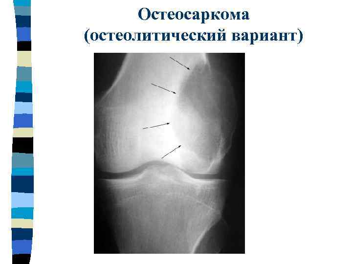 Остеосаркома (остеолитический вариант) 