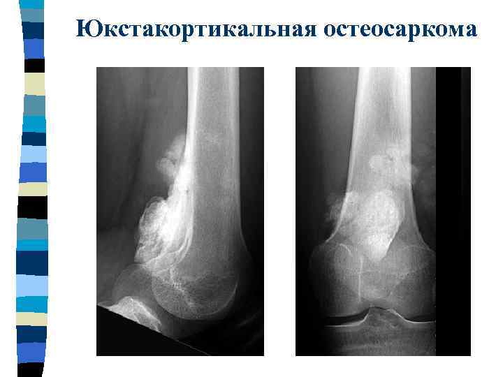 Первичные злокачественные опухоли костей особенности рентгеновской картины