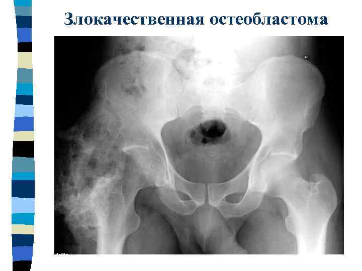 Злокачественная остеобластома 