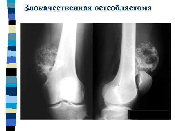 Злокачественная остеобластома 