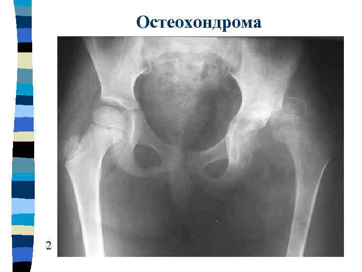 Остеохондрома бедренной. Остеохондрома подвздошной кости рентген. Хондросаркома тазобедренного сустава. Остеохондрома бедренной кости. Остеохондрома кости рентген бедренной кости.