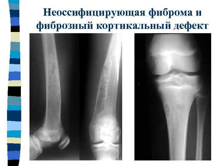 Фиброзная дисплазия большеберцовой кости