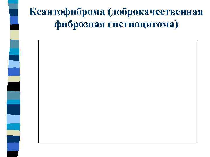 Ксантофиброма (доброкачественная фиброзная гистиоцитома) 