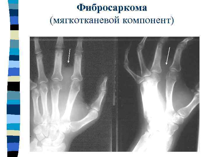 Фибросаркома (мягкотканевой компонент) 