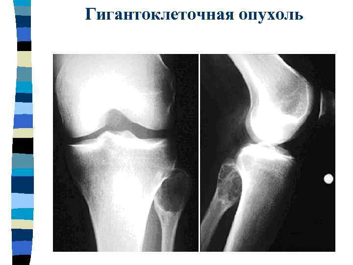 Рентгенологическая картина гигантоклеточной опухоли характеризуется разновидностями