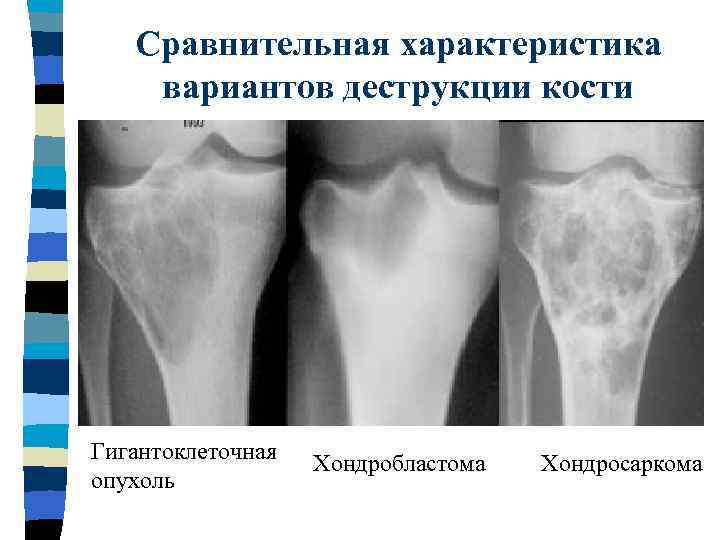 Рентгенологическая картина гигантоклеточной опухоли характеризуется разновидностями