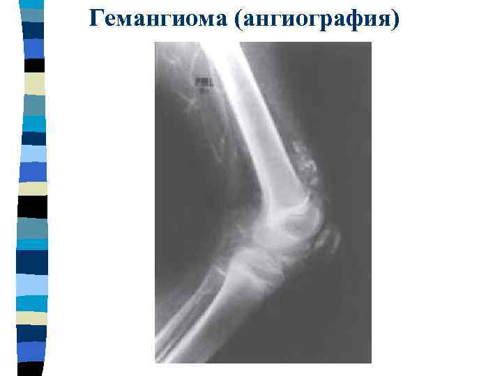 Гемангиома (ангиография) 