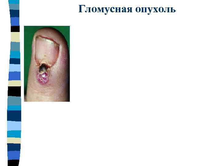 Гломусная опухоль 